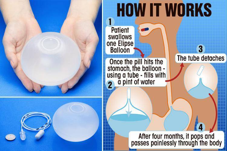 Weight Loss Balloon Pill >> The Elipse Balloon Spinoff Com Weight Loss Balloon Pill >> The Elipse Balloon Spinoff Com